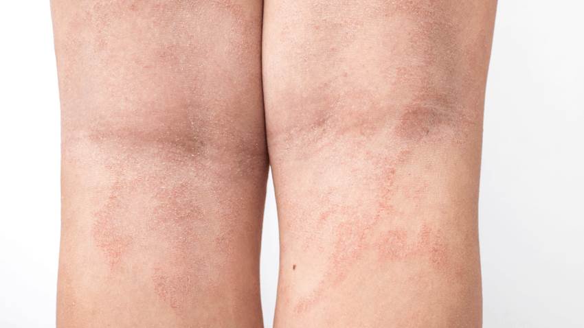 Estudio demuestra superioridad de RINVOQ® para tratar la dermatitis atópica