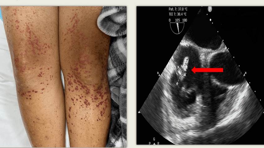 Endocarditis de la válvula tricúspide provoca extraño tipo de vasculitis leucocitoclásticas en paciente