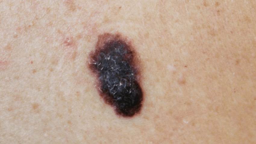 Explorarse la piel con frecuencia para prevenir el melanoma