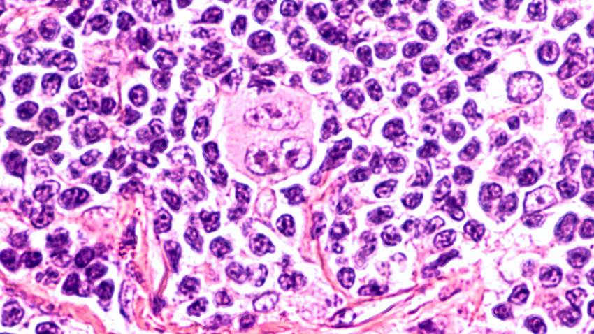 ¿Cuáles son las causas de linfoma?