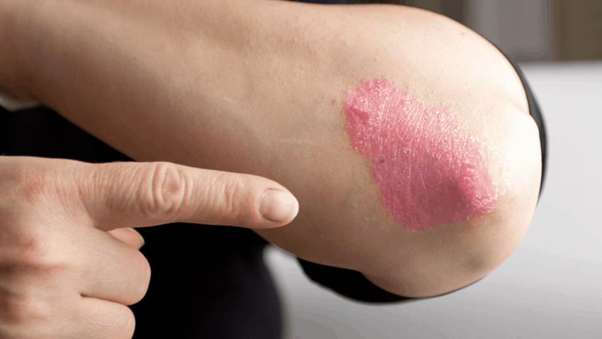 SKYRIZI® ahora disponible en los EE.UU. en inyección única de 150 mg para adultos con psoriasis