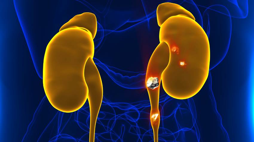 Pacientes con cálculos en el riñón tienen un riesgo mayor de desarrollar síndrome metabólico