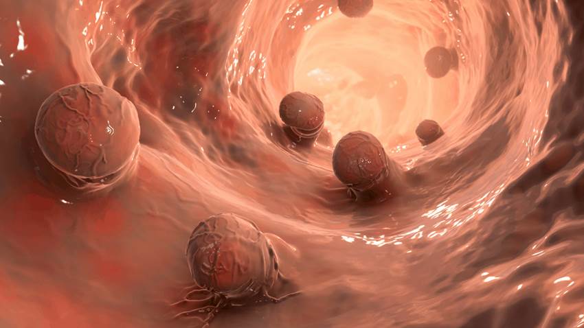 Estudio comprueba que una reinserción incompleta puede aumentar el desarrollo de pólipos colorrectales