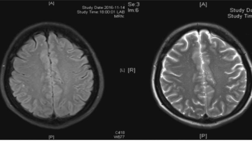 Paciente con síndrome de Sjogren registra infección causada por hongo en pulmones y en zona ósea