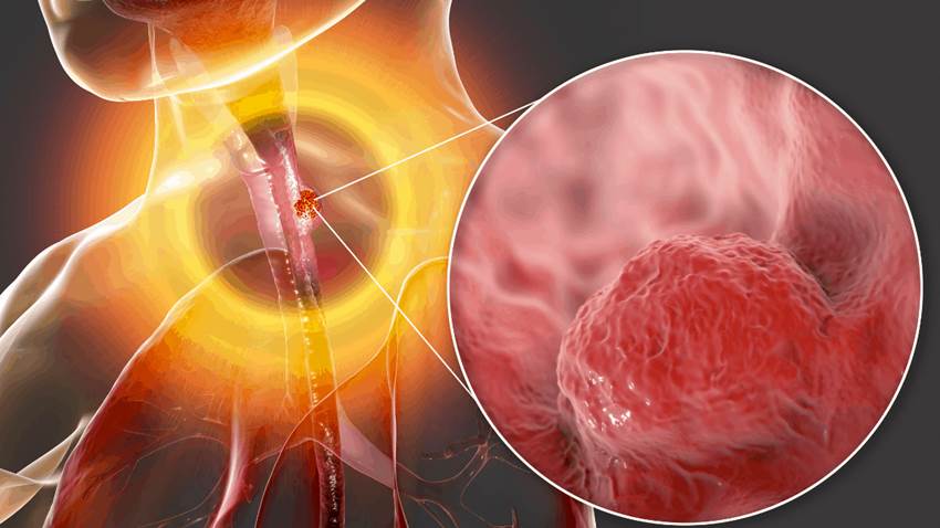 Investigadores confirman que el adenocarcinoma esofágico siempre va precedido de esófago de Barrett