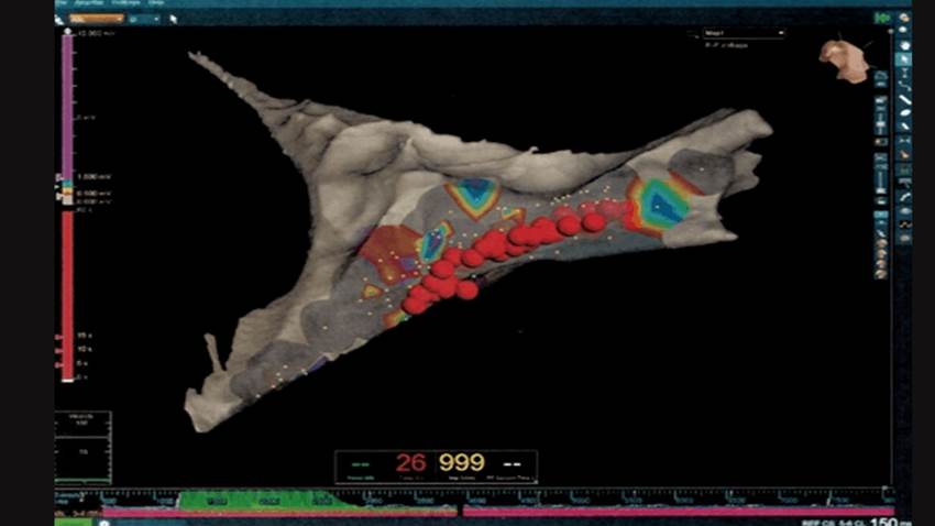 Arritmia cardíaca de adulto mayor se registra en paciente pediátrico con epilepsia severa