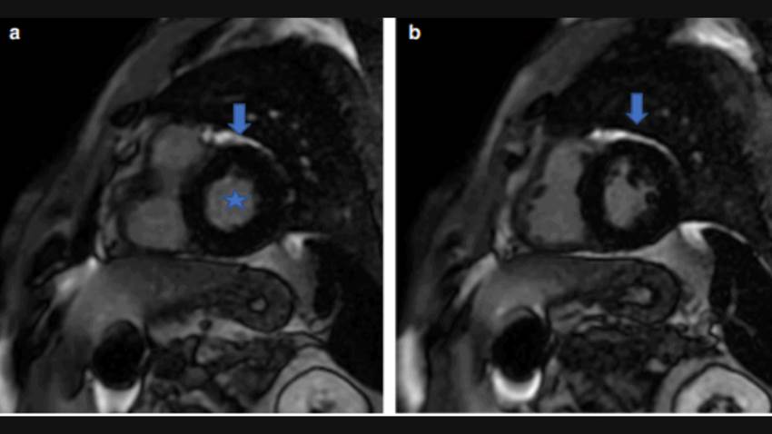 Rara complicación cardíaca se registra en paciente contagiado con COVID19, instando al uso del ECG
