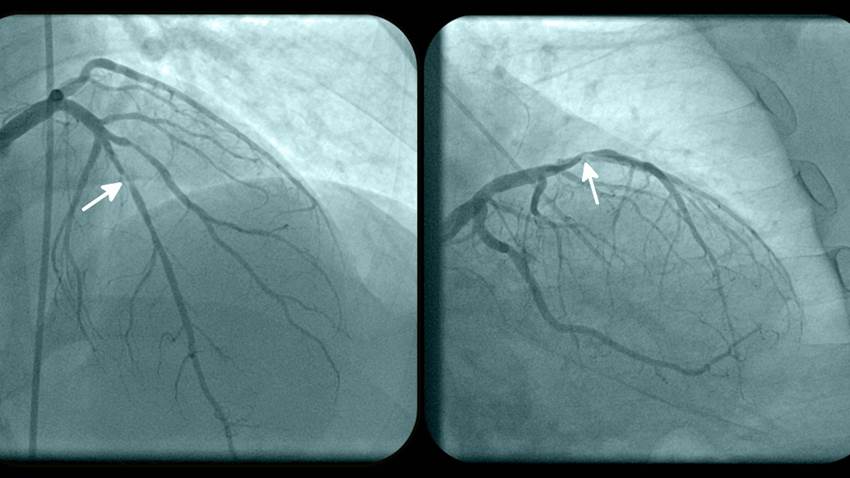 Estudio demuestra que inhibidor es efectivo en insuficiencia cardiaca con fracción de eyección preservada