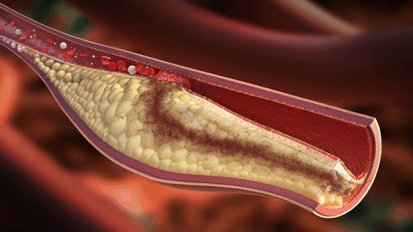 Estudio confirma relación entre el colesterol en sangre y riesgo de demencia