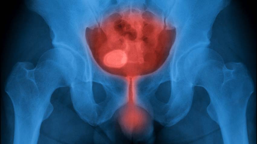 Uso de antibióticos durante una o dos semanas es eficaz en infección de vías urinarias en hombres