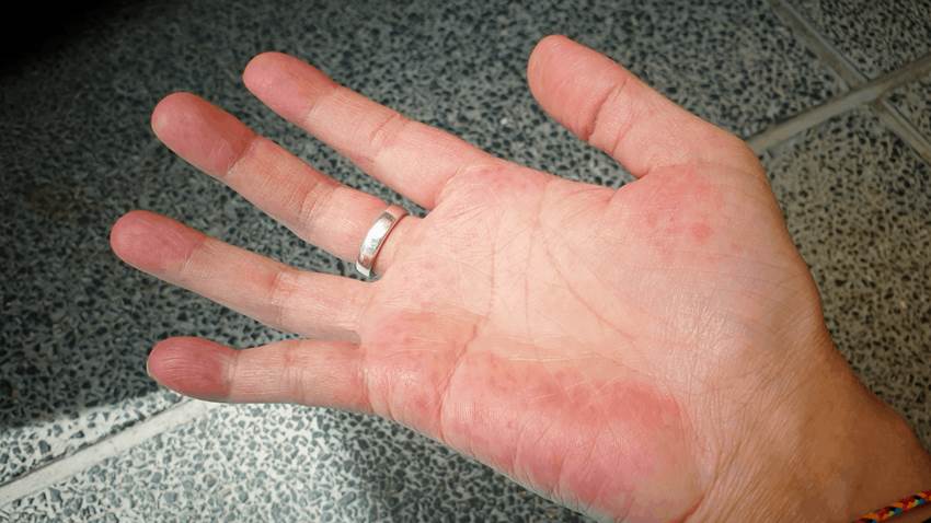 ¿Qué es el lupus? Estos son sus síntomas y su tratamiento