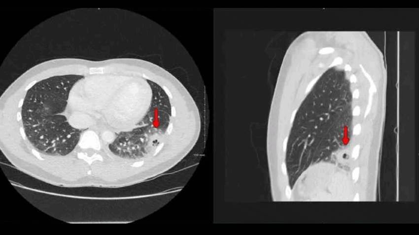 Paciente con COVID-19 desarrolla enfermedad pulmonar cavitaria como complicación a largo plazo del virus