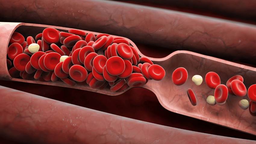 Qué son los coágulos sanguíneos y a quienes afecta