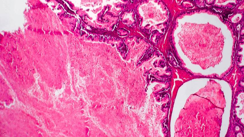 Estudio sostiene que pastillas anticonceptivas pudieran prevenir el cáncer de ovario