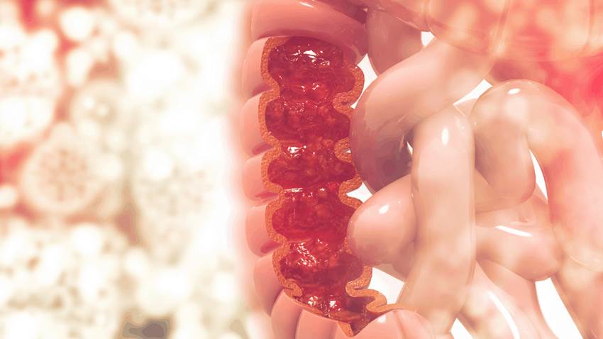 Uso moderado de antibióticos aumentaría el riesgo de cáncer de colon