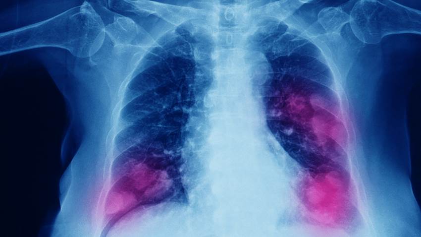 Pacientes con cáncer de pulmón de células no pequeñas se beneficiarían del atezolizumab posquirúrgico