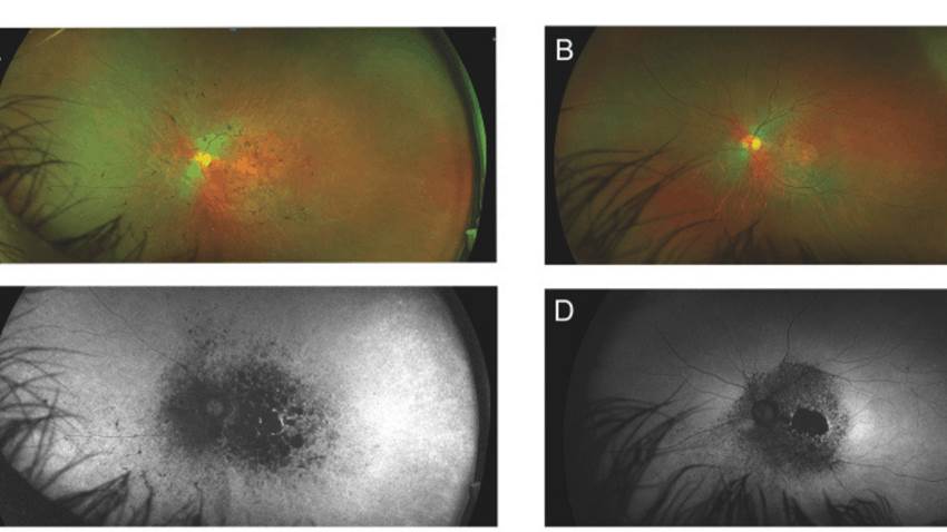 Raro caso de hermanos con síndrome genético con distintas manifestaciones clínicas se presenta en la isla