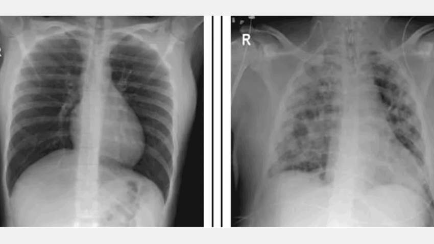 Se registra caso de coinfección entre COVID-19 y dengue con síndrome respiratorio agudo severo