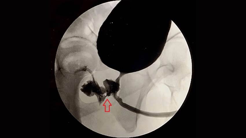Revés científico: se registra caso de paciente que eyaculaba por el recto y presentaba heces en la orina