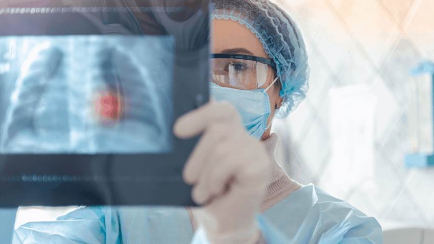 Tecnología artificial permitiría detección del cáncer pulmonar un año antes de lo habitual