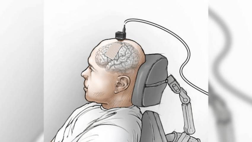 Implante cerebral ayuda a un hombre a hablar a través de una computadora