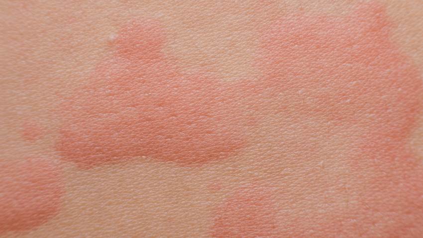 Miel artesanal causa anafilaxia en niño de 5 años