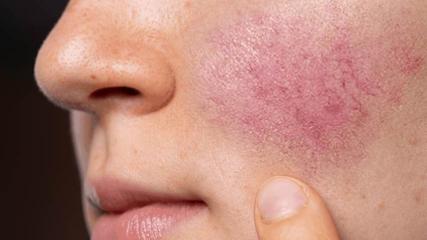 Los fármacos vasodilatadores podrían proteger contra la rosácea