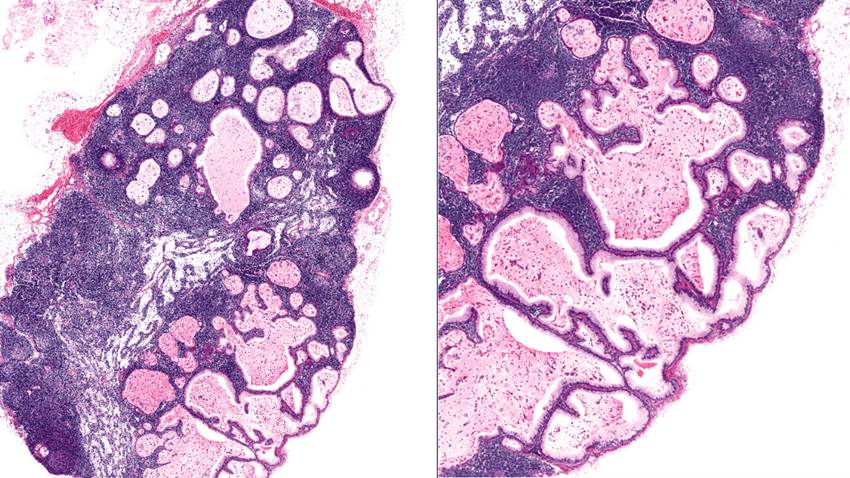 Científicos identifican causa genética de la endometriosis