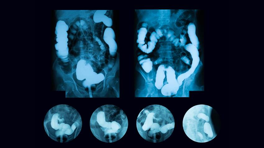 Cáncer de colon: Reducir el uso innecesario de antibióticos