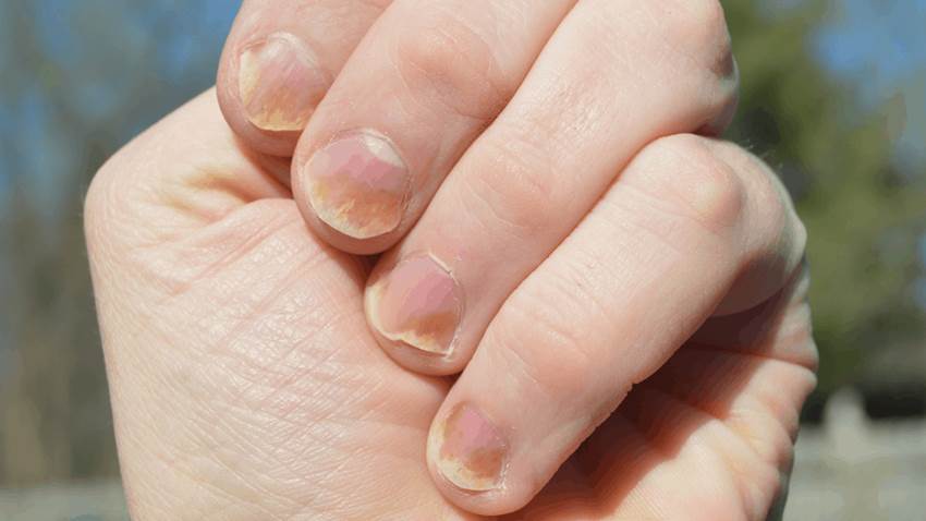 Psoriasis en las uñas y articulaciones de los pies: Consejos para tratar y aliviar esta enfermedad