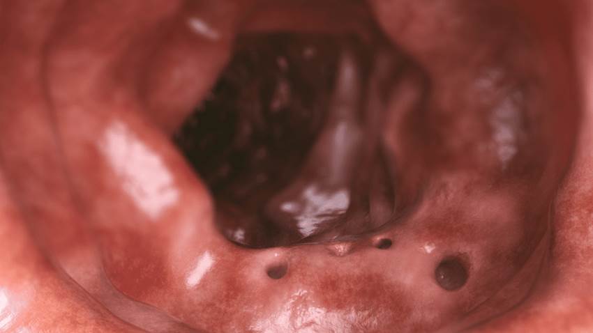 Enfermedad diverticular puede aumentar el riesgo de cáncer de pulmón en un 50 %