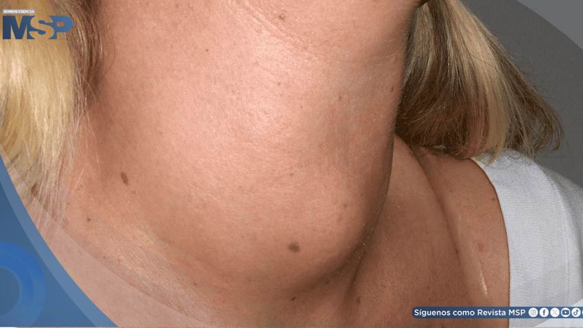 Masa cervical progresiva y disfagia leve revelan bocio multinodular eutiroideo en mujer de 48 años