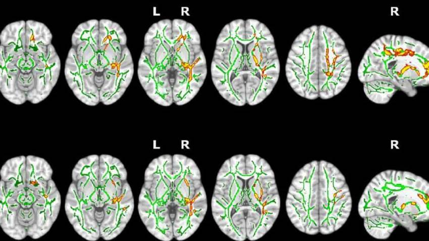Los síntomas de insomnio podrían provocar problemas de insuficiencia cardiaca, según estudio