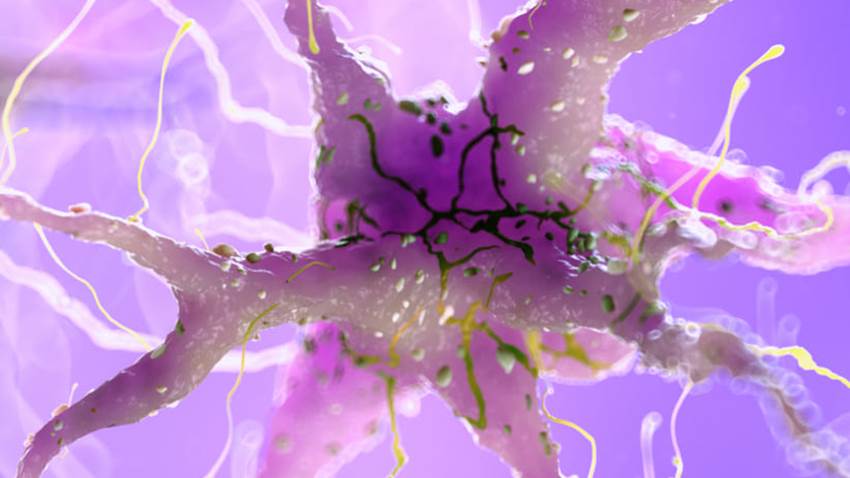 El alcohol sigue dañando el cerebro incluso cuando ya se ha dejado de beber