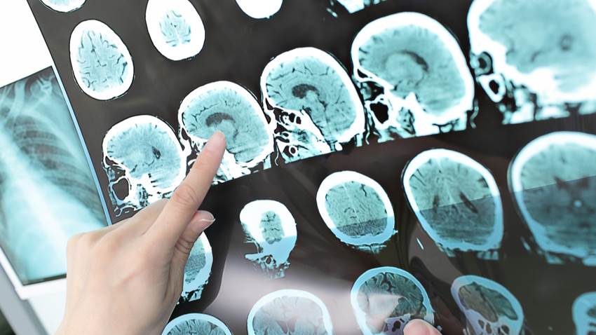 10 síntomas que se pueden manifestar en la esclerosis múltiple