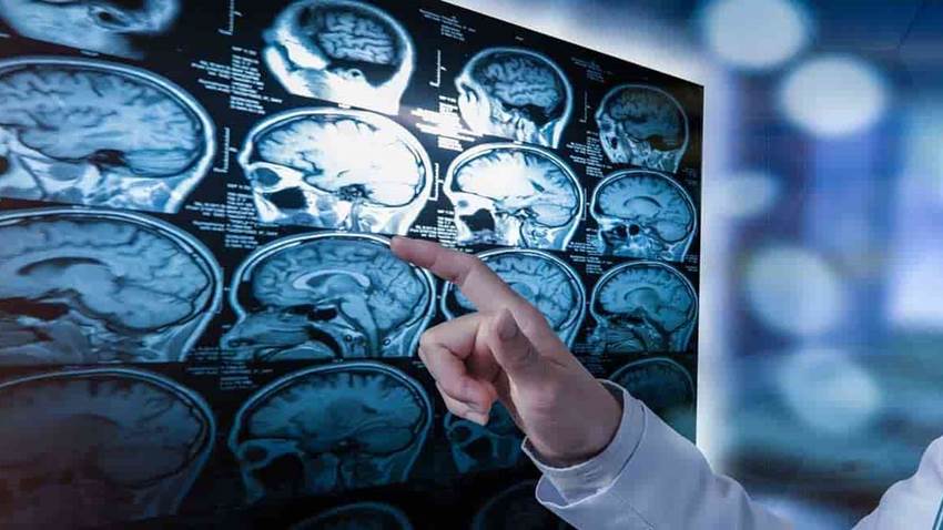 Síntomas tempranos de la esclerosis múltiple