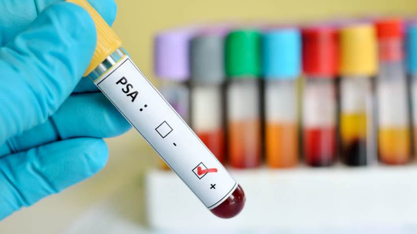 Cáncer de próstata podría ser detectado con nuevo análisis de sangre