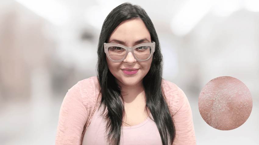 Ketsy Román: la puertorriqueña que creó un grupo de apoyo para los pacientes con dermatitis atópica