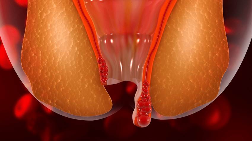 ¿Ha tenido alguna vez hemorroides? Todo lo que debe saber sobre esta afección