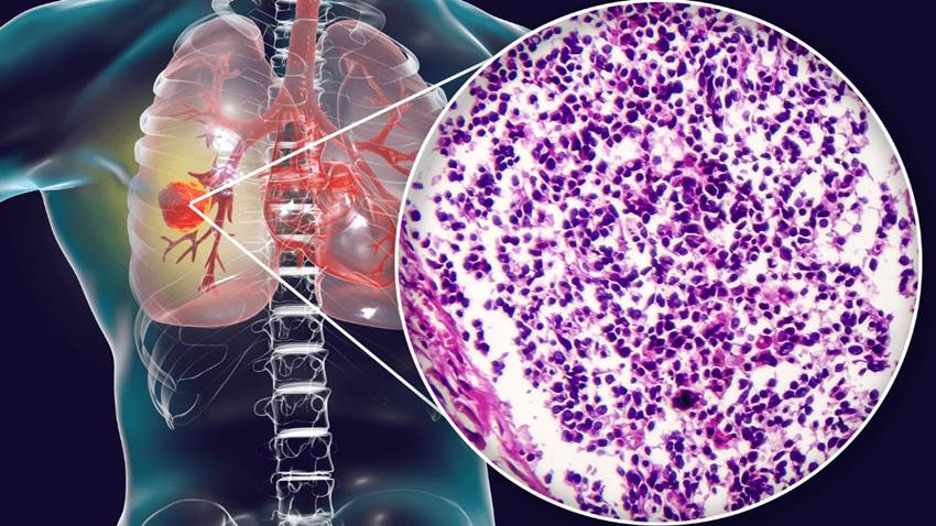 Terapia combinada en ratones demuestra potencial para detener el cáncer de pulmón de células pequeñas