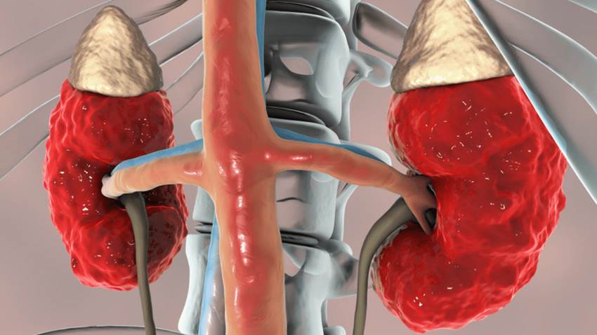 Estudio comprueba que la anemia aumenta a medida que la enfermedad renal crónica empeora