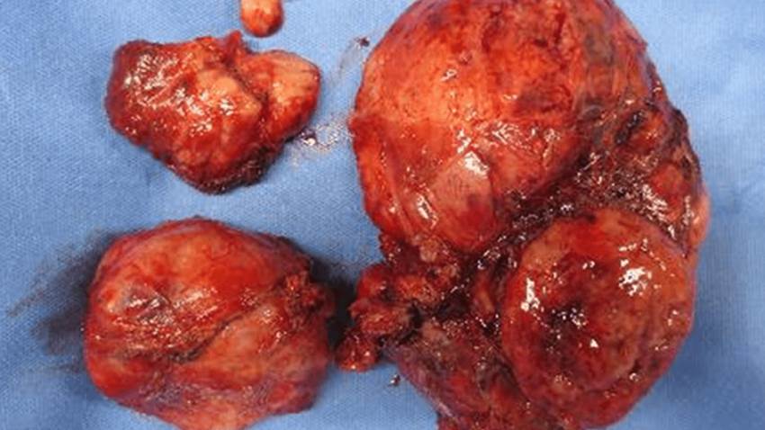 Exitoso tratamiento quirúrgico por tumor fibroso solitario pélvico acompañado de síndrome de Doege-Potter