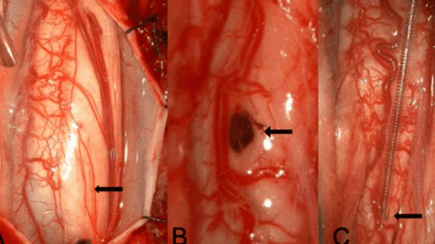 Laminectomía bilateral con durotomía como tratamiento para pacientes con quistes en la columna