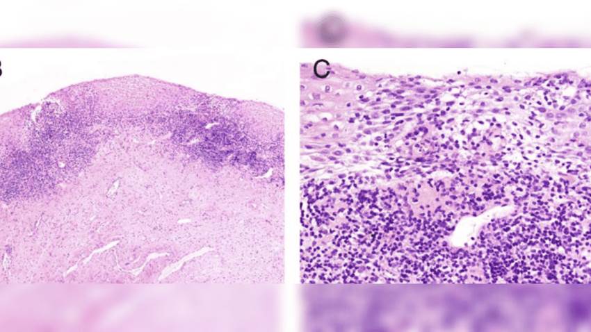 Vaginitis inflamatoria, vulvitis de células plasmáticas y el riesgo de vaginitis hemorrágica