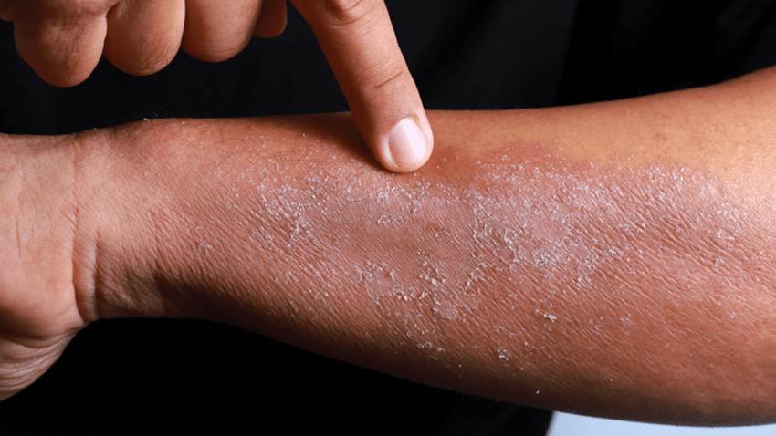 Ácaros, levadura y mascotas: alergias identificadas en pacientes con dermatitis atópica en Puerto Rico