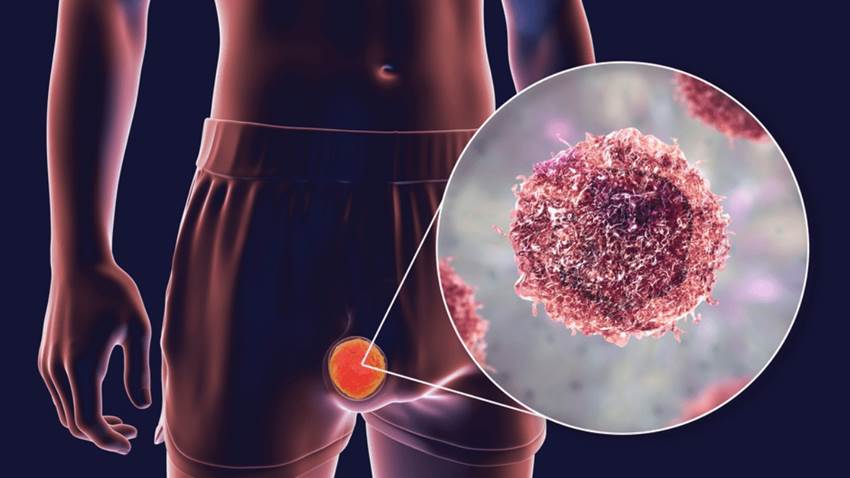 Reconozca los síntomas del cáncer testicular que pueden pasar inadvertidos