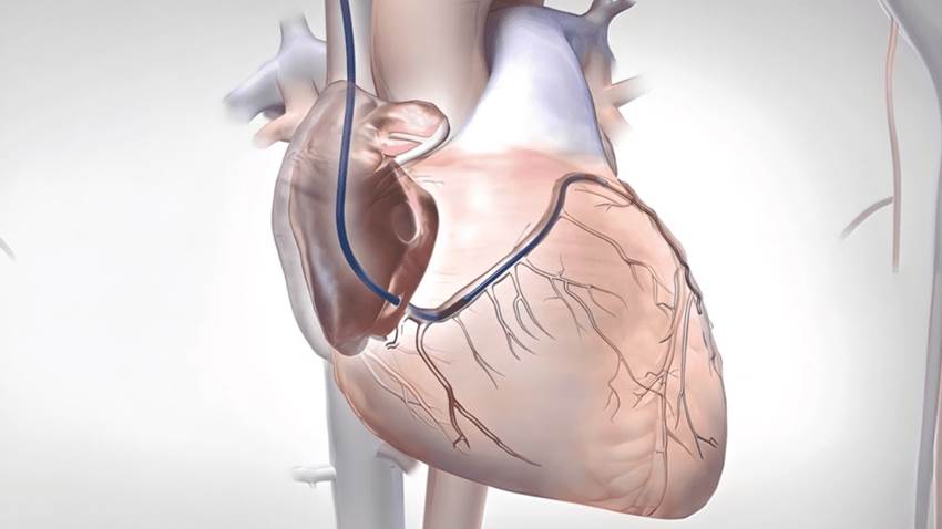 Rivaroxabán para la fibrilación auricular en la cardiopatía reumática