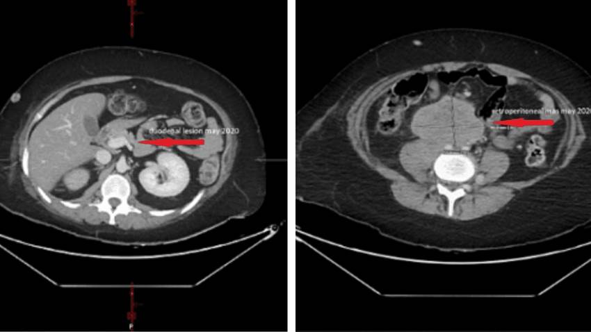 Paciente presentó sangrado gastrointestinal agudo debido a un carcinoma en el cuello uterino