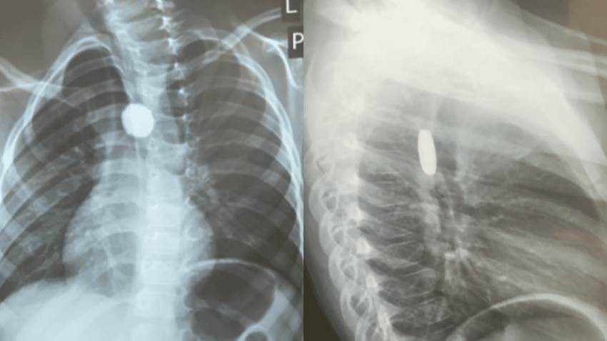 Extraen batería del esófago de un niño puertorriqueño mediante endoscopia digestiva