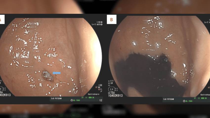 Logran reparar fístula gastrobronquial mediante cirugía abierta